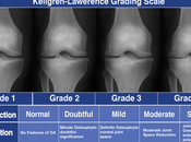 Arthritis Knee? Here’s What Know