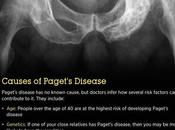 Paget’s Disease: Symptoms, Causes Treatment