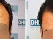 Hair Transplant Cost Guwahati India