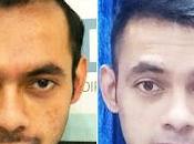 What Makes Popular Place Hair Transplant Lucknow?