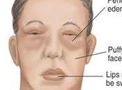 Herbal Remedies Nephrotic Syndrome