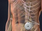 Intrathecal Pumps Market 2021-2026: Research Report Size, Share Trends