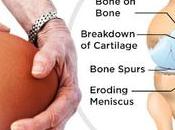 Osteoarthritis Treatment Includes Several Medicinal Non-Medicinal Methods, Including Drugs Exercises