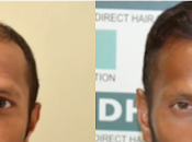 Select Best Hair Transplant Clinic Kolkata?