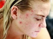 Need Know About Symptoms Causes Actinic Keratosis