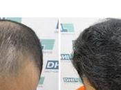 Best Hair Transplant Clinic Guwahati Ensures Guaranteed Results