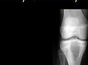 Aneurysmal Bone Cyst Ayurvedic Treatment