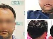 Treatment Affordable Hair Transplant Cost Kolkata India