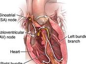 Ayurvedic Treatment (RCA) Right Coronary Artery Blockage