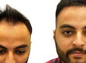 Want Achieve Lifetime Results? Best Hair Transplant Jaipur Fulfill Your Dream!