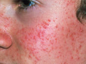 Global Sirolimus Market Industry Analysis, Size, Share, Growth, Trends, Forecast, 2019 2026