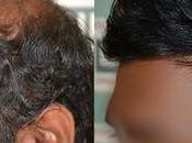 Best Hair Restoration Beard Transplant Kolkata