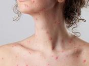 Natural Cure Shingles Herpes Zoster