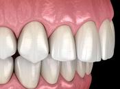 Dental Solutions Crowded Teeth, Overbite, Spaced Teeth