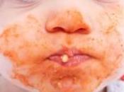 Overview Common Food Allergies Children