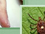 Rocky Mountain Spotted Fever (RMSF) Ayurvedic Management