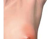 Clogged Milk Ducts While Breastfeeding