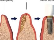 Understanding Bone Grafts Dental Implants