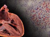 Exploring Treatment Familial Amyloid Cardiomyopathy