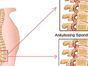 Chronic Inflammatory Disease Spine, Ankylosing Spondylitis (AS) Occurs Axial Spine