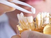 Benefits All-On-Four Dental Implants