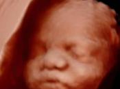 Baby With Lips Ultrasound: Should Worried?