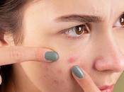 Effectively Deal with Pimples Acne During Monsoon Season