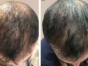 Minoxidil Market Reach 951.8 Million 2020 Witness High Growth Owing Increasing Demand Hair Loss Treatment