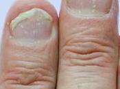 Nail Psoriasis: Causes, Symptoms, Prevention, Treatments, Medication