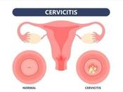 Cervicitis Causes, Symptoms Herbal Treatment