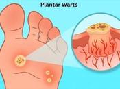 Plantar Warts Causes, Symptoms, Ayurvedic Treatment