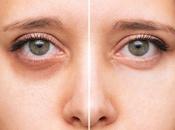Minimally Invasive Treatments Dark Circles Under Eyes
