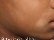 Ayurvedic Treatment Pityriasis Alba with Herbal Remedies