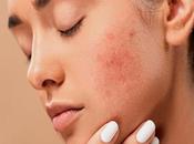Natural Treatment Acne With Herbal Remedies