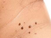 Facts About Skin Tags Can’t Remove From Truth