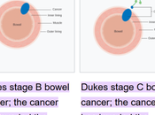 Colorectal Carcinoma Duke Staging Management