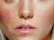 Best Foundation Acne Prone Skin