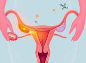 Understanding Managing Endometritis South Africa