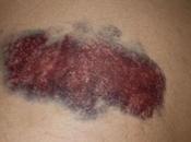 Signs That Indicate Have Leukemia, Should Never Ignore