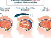 Post-Concussion Syndrome Concussion: Similarities Differences