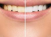 What Affects Teeth Whitening Cost Singapore? Factors Explained