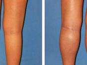 Know About Calf Implants Augmentation Surgery