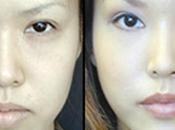 Appealing Eyes with Asian Blepharoplasty