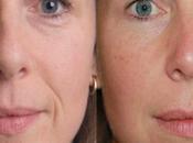 Cosmetic Dermal Fillers Benefits, Cost Side Effects