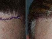 Hair Transplant Procedures Choose From