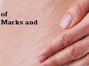 Proven Ways Stretch Marks Scars