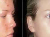 Cure Acne Naturally Powerful Natural Remedies That Clear Your Skin Fast
