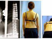 Friday Q&amp;A: Yoga Surgically Repaired Scoliosis