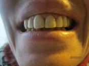 Weight Gain Recovery