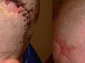 Treat Scar Tissue Scalp?